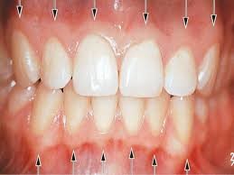 Gum disease consultation at Planet Family Dental Lynnwood WA