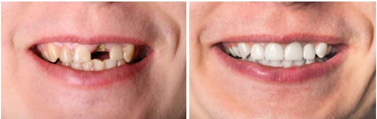 Professional dental cleaning at Planet Family Dental