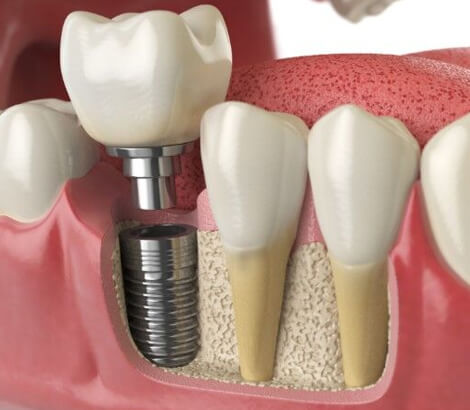 Dental Implants in Lynnwood