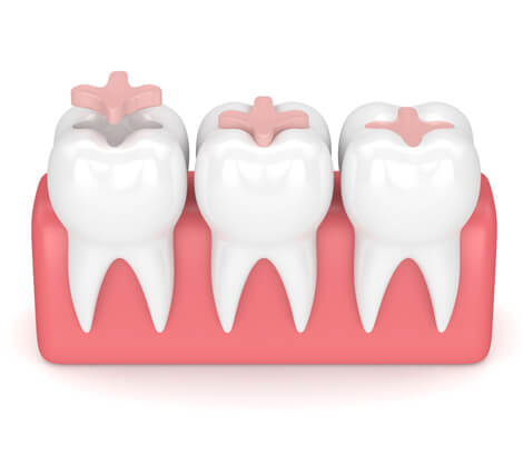 All About Dental Inlays