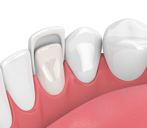 Porcelain Veneers in Lynnwood