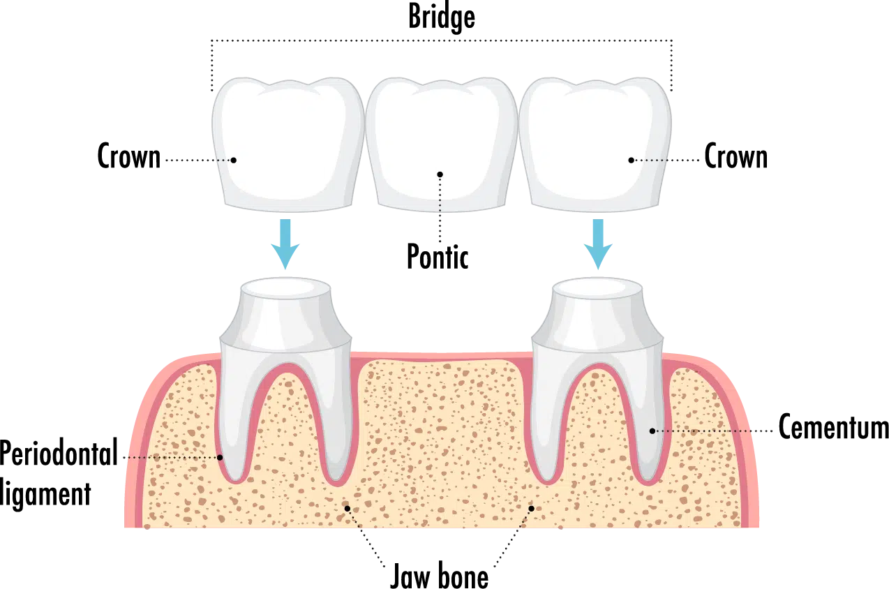 Dental bridge diagram